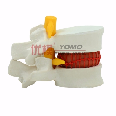 腰椎間盤突出演示模型